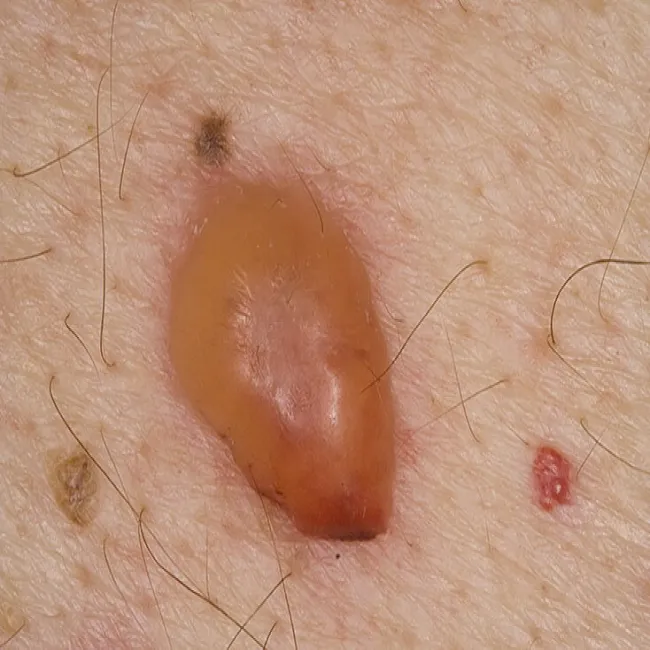 Pemfigoid pęcherzowy 