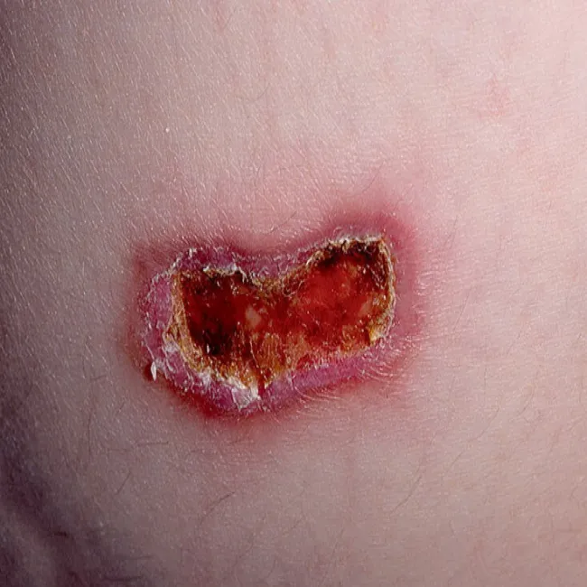 Piodermia zgorzelinowa na skórze