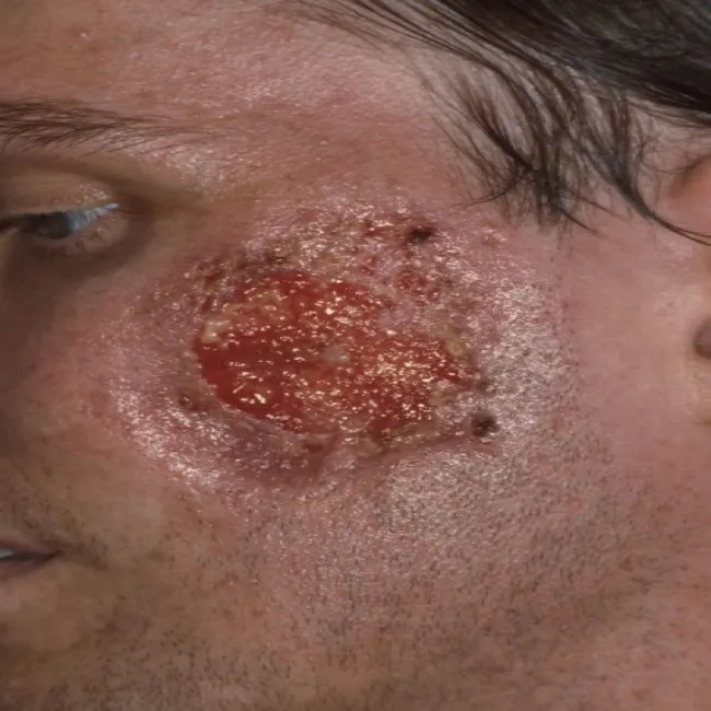 Piodermia zgorzelinowa na twarzy