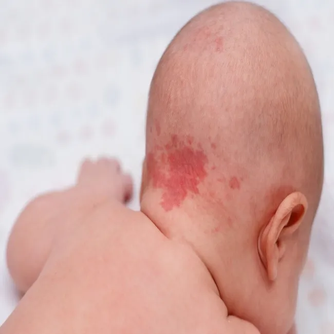 Plama łososiowa u dziecka
