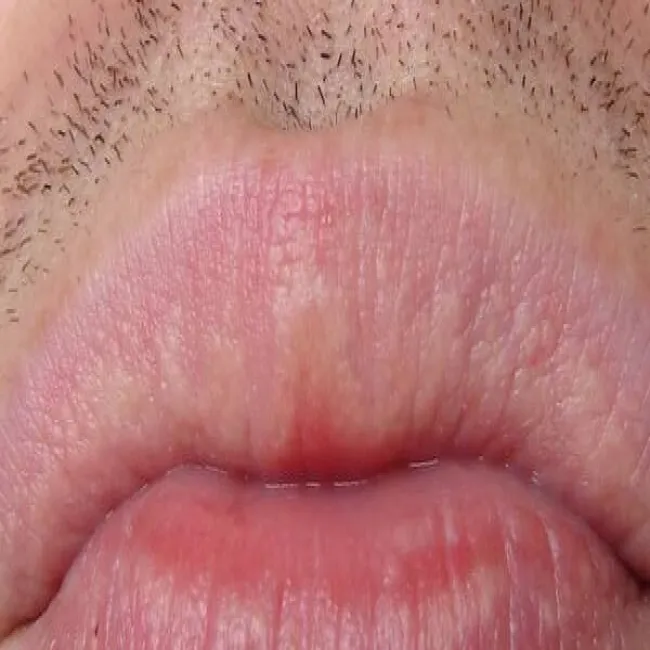 Plamki Fordyce'a na ustach