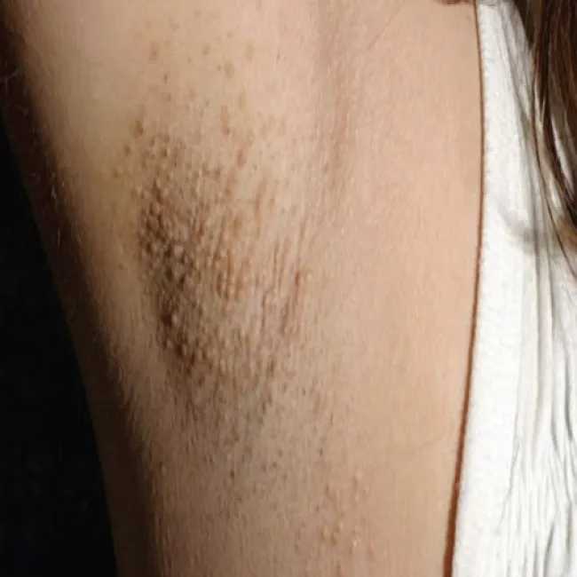 Plamki fordyce'a pod pachą