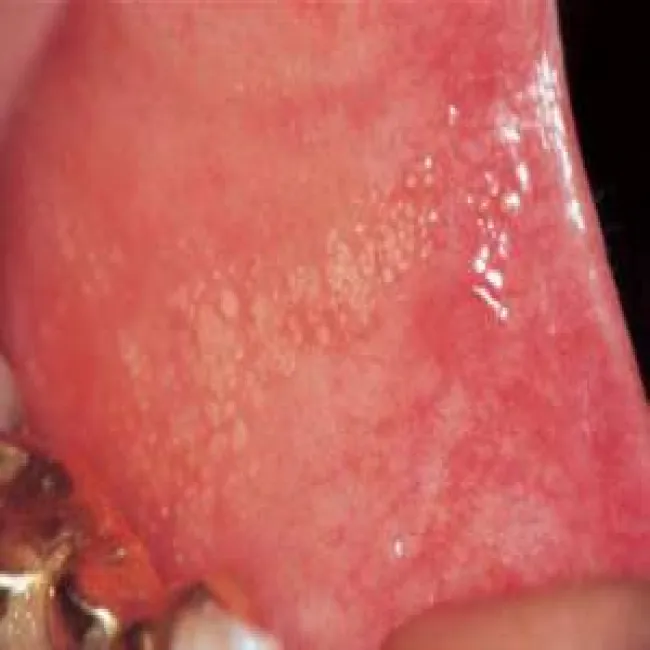 Plamki fordyce'a w jamie ustnej