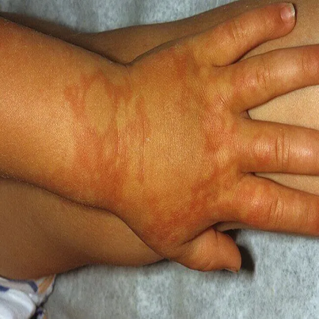 Plamy na dłoniach u dzieci rumień zakaźny