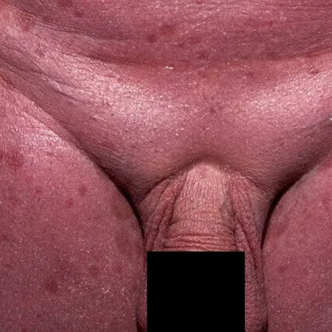 Plamy na skórze miejsca intymne zespół Sezary’ego 