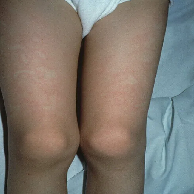 Plamy na skórze u dziecka na nogach rumień zakaźny