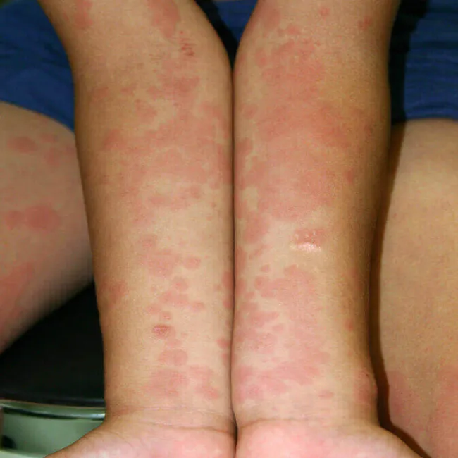 Plamy na skórze u dziecka na rękach rumień zakaźny