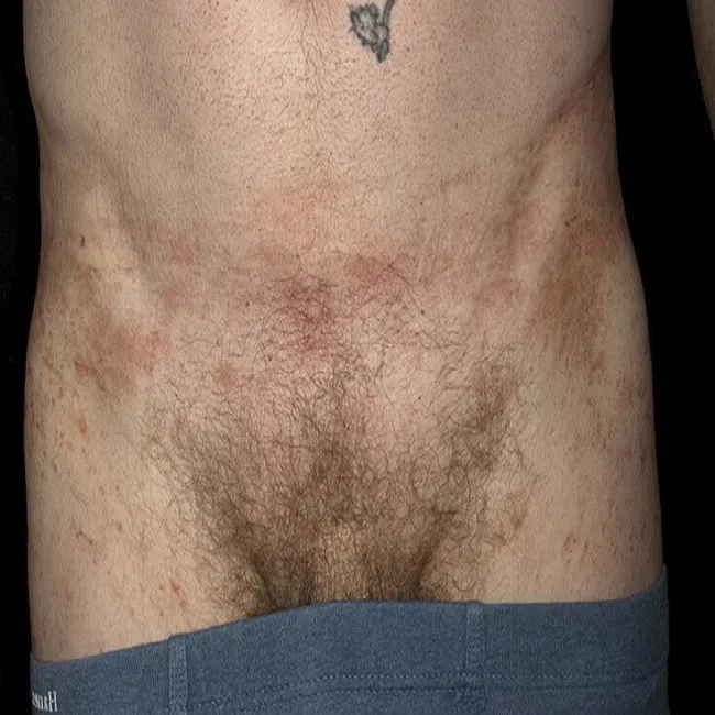 Plamy na skórze u mężczyzn 