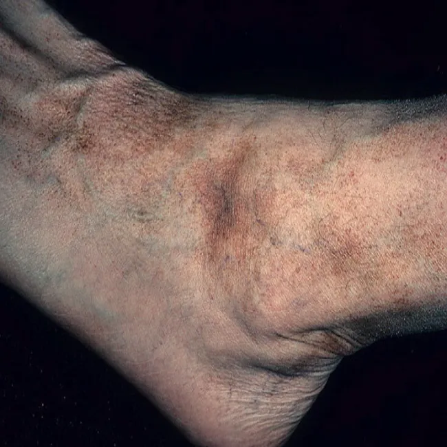 Plamy na stopach choroba Schamberga