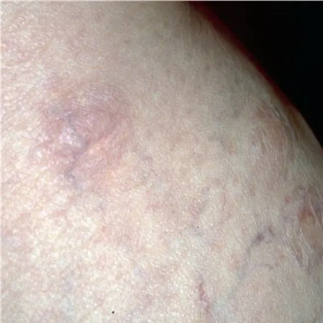 Plamy niebieskawe na skórze - zanik plamisty skóry