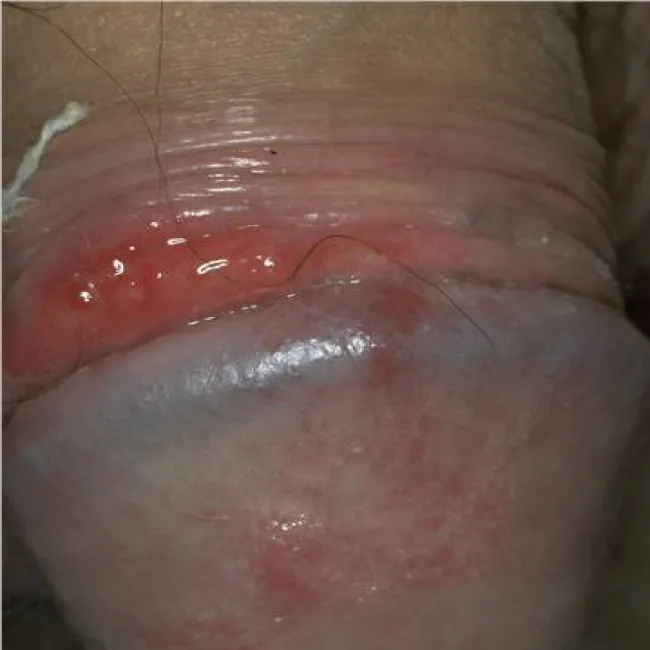 Plasma cell balanitis