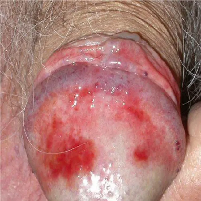 Plasma cell vulvitis