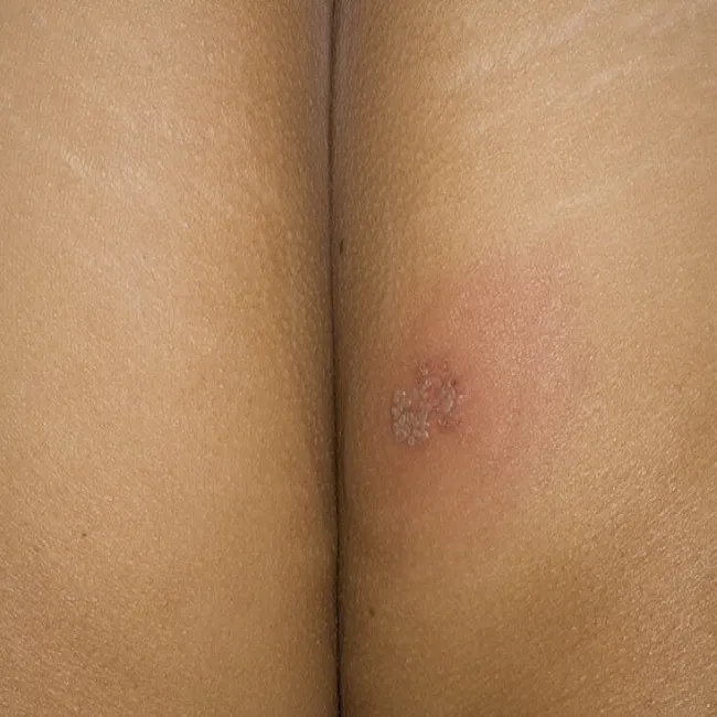 Pośladek opryszczka