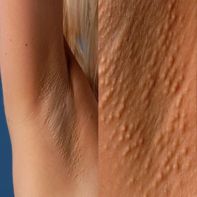 Pod pachą guzki choroba Foxa-Fordyce'a