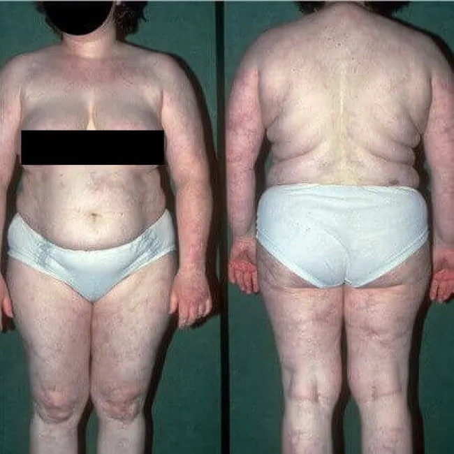 Podrogowa dermatoza krostkowa objawy