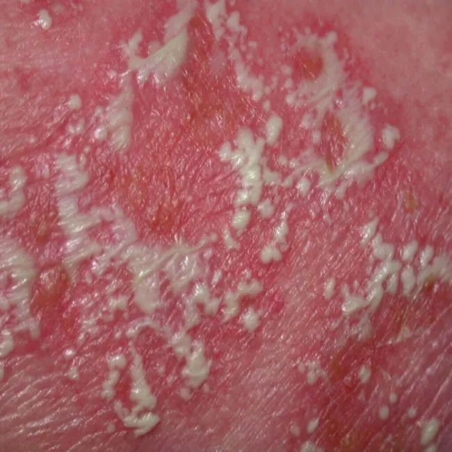 Podrogowa dermatoza krostkowa zdjęcie