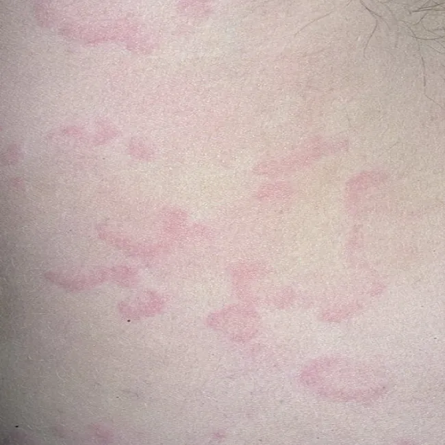 Pokrzywka alergiczna żywność orzechy