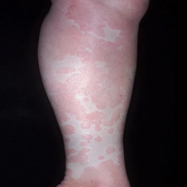 Pokrzywka alergiczna na słońce