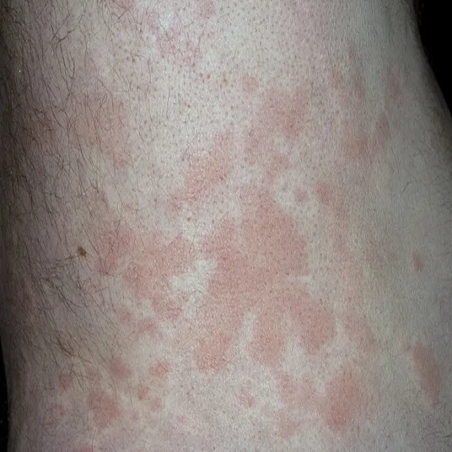 Pokrzywka alergiczna na stres