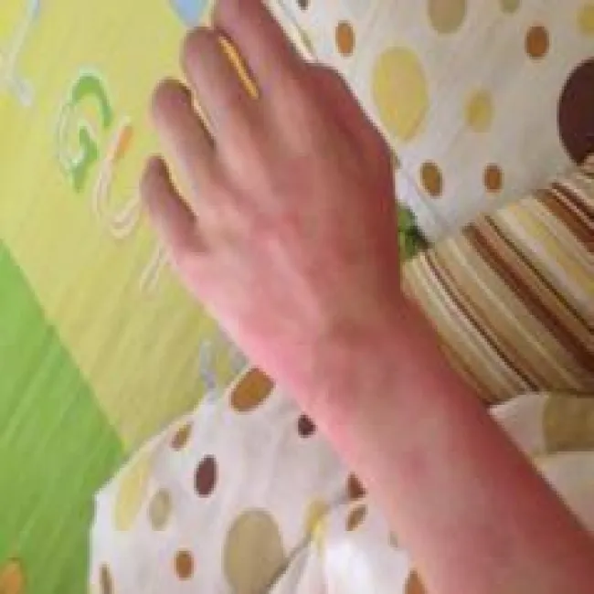 Pokrzywka cholinergiczna na dłoni