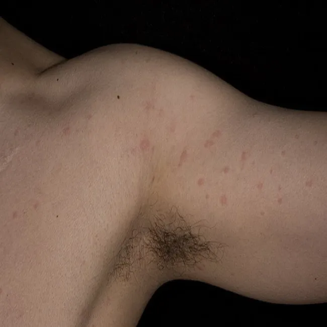 Pokrzywka cholinergiczna na ręce