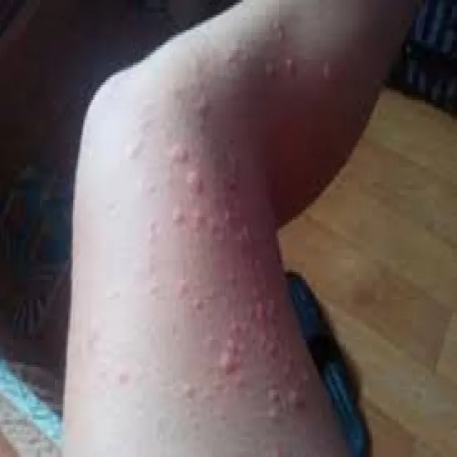 Pokrzywka cholinergiczna u dzieci