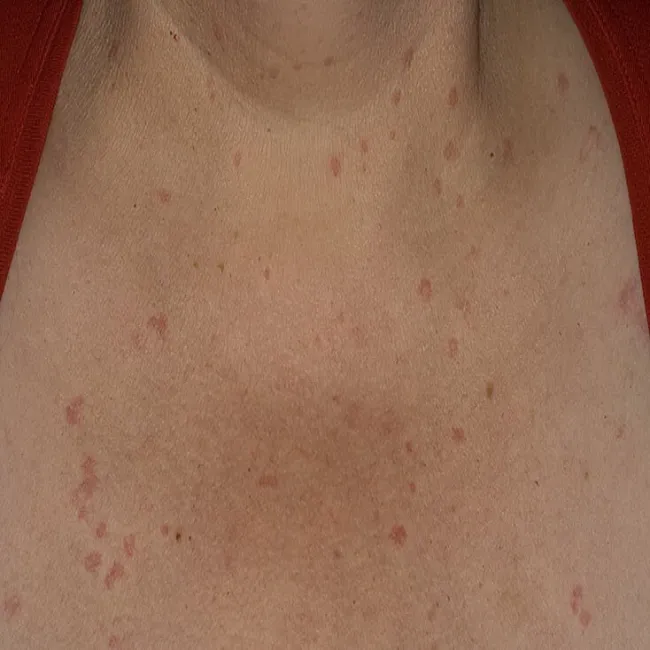 Pokrzywka cholinergiczna zdjęcie