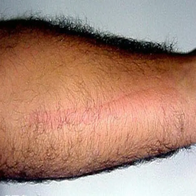 Pokrzywka dermograficzna na ręce