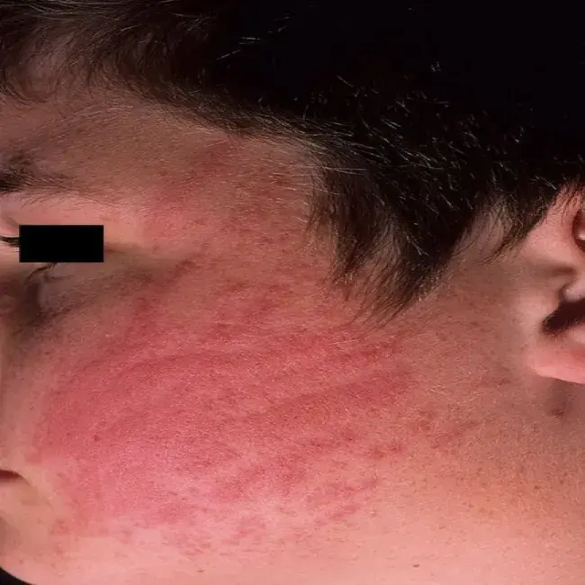 Pokrzywka dermograficzna na twarzy