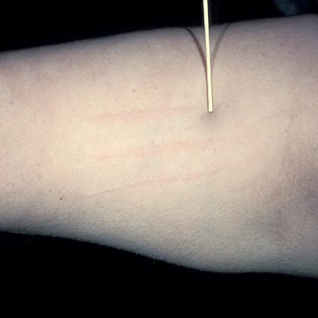 Pokrzywka dermograficzna obrazy   