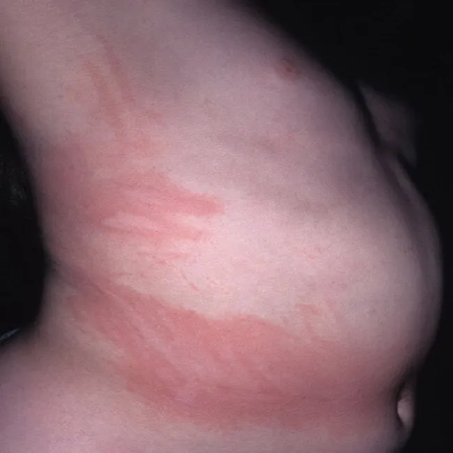 Pokrzywka dermograficzna u dziecka zdjęcie