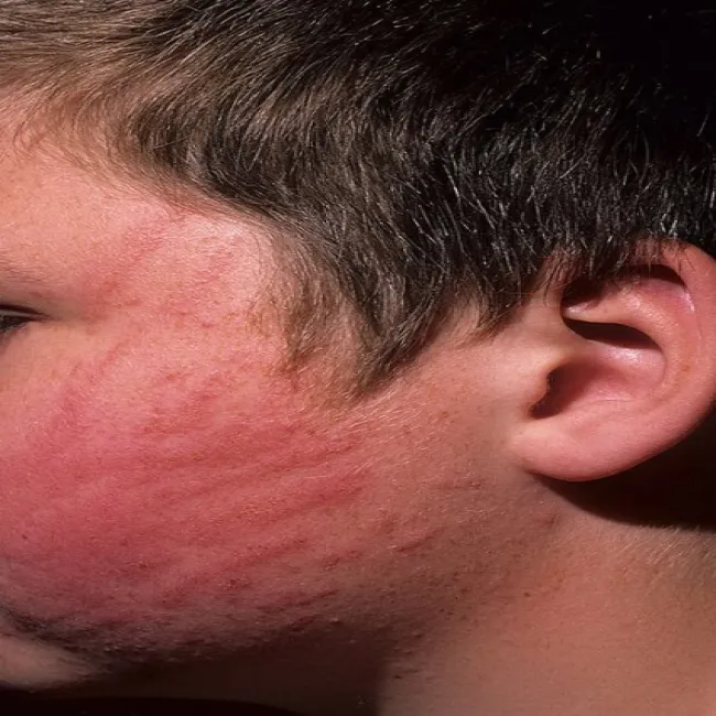 Pokrzywka u dzieci dermografizm 