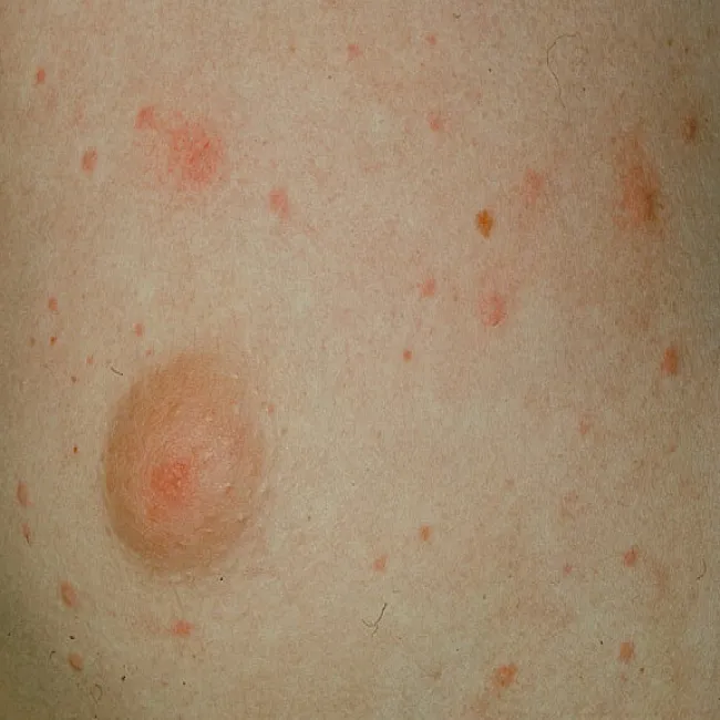 Pokrzywka u sportowców pokrzywka cholinergiczna 