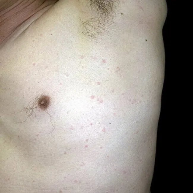 Pokrzywka u trenujących pokrzywka cholinergiczna 