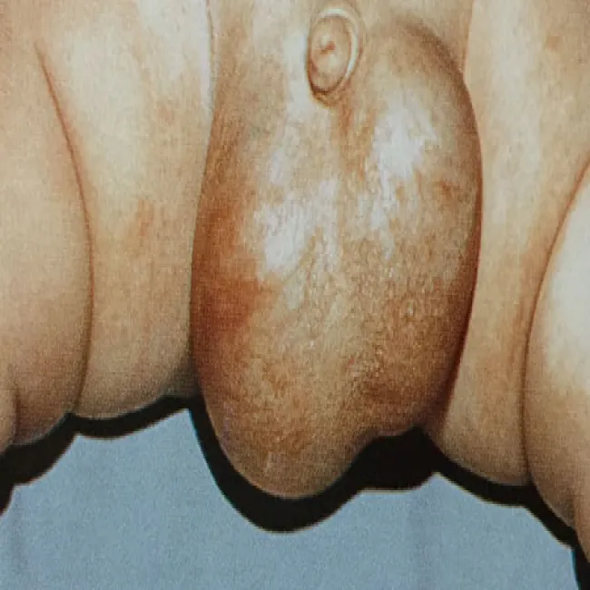 Powiększenie jąder u dziecka wodniak