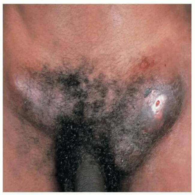 Powiększone węzły chłonne pachwinowe