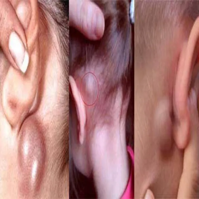 Powiększone węzły chłonne za uszami