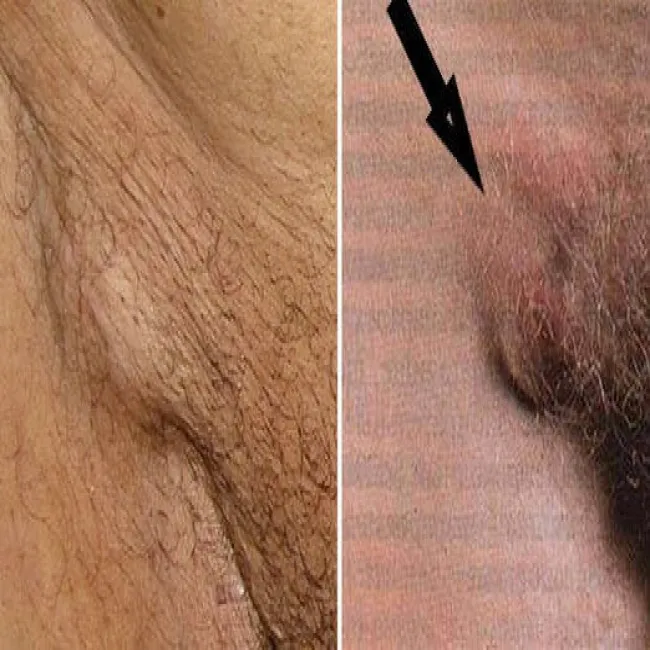 Powiększony węzeł chłonny w pachwinie 