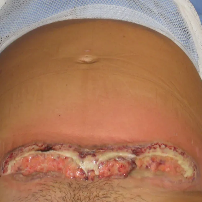 Powikłania po cesarskim cięciu piodermia zgorzelinowa