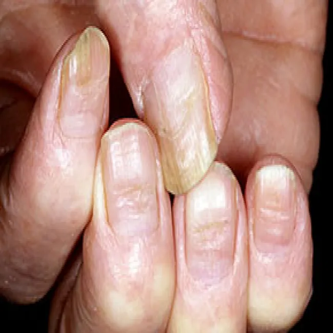 Poziome bruzdy na paznokciach