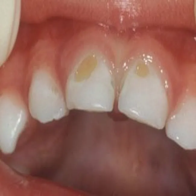 Próchnica butelkowa u 2 latka