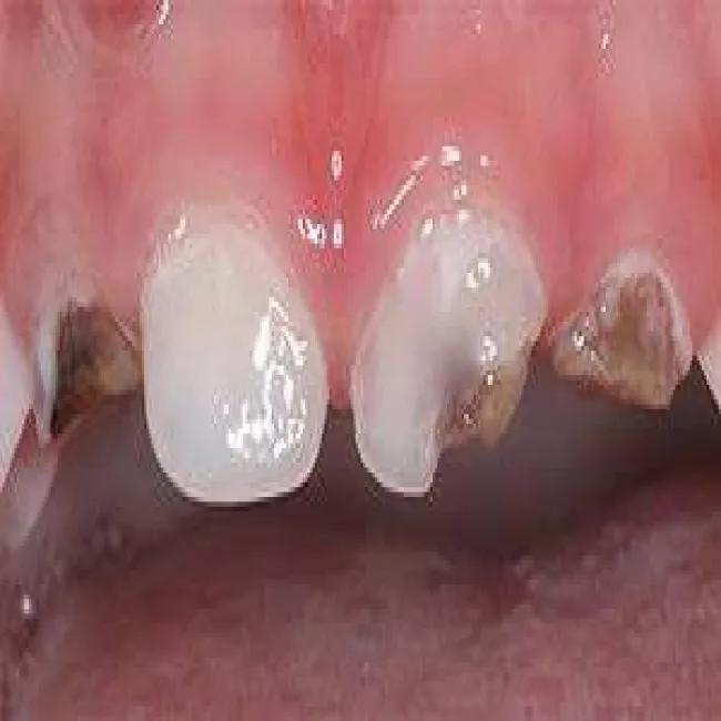 Próchnica u dwulatka 