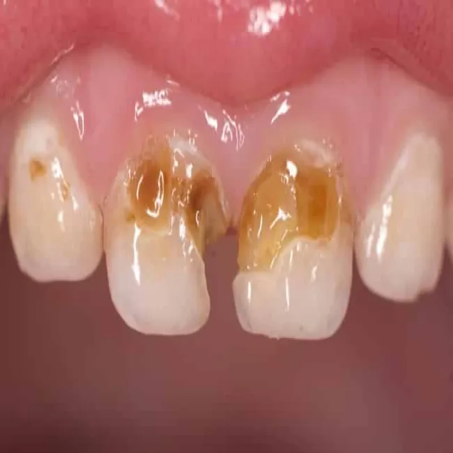 Próchnica zębów mlecznych