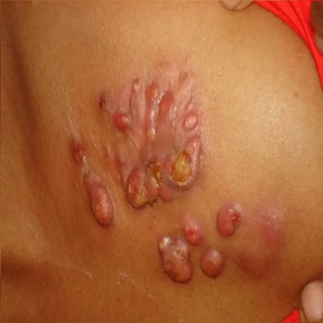 Promienica na skórze