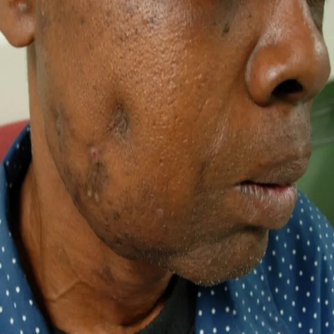 Promienica szyjno-twarzowa