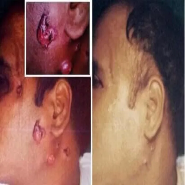 Promienica zdjęcia choroby