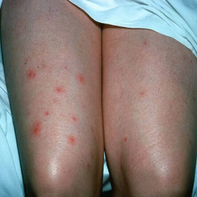 Pryszcze na udach 