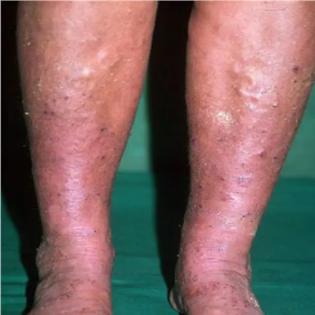 Przebarwienia na nogach wyprysk podudzi