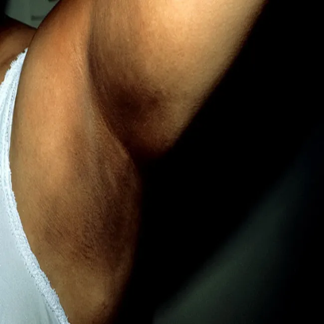 Przebarwienie skóry pod pachą choroba Addisona