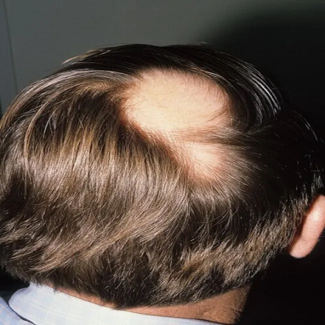 Przerzedzenie włosów na czubku głowy